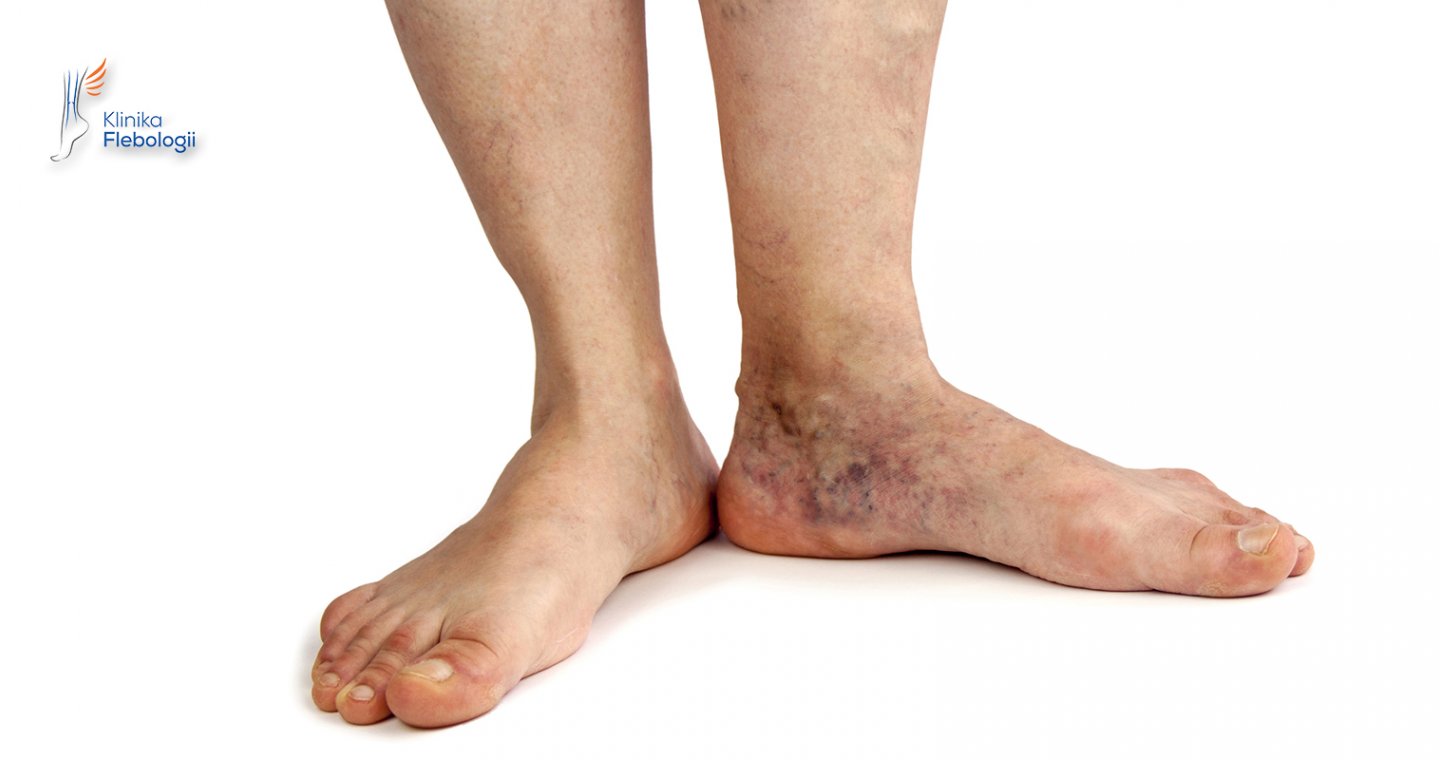 Zespół pozakrzepowy objawy