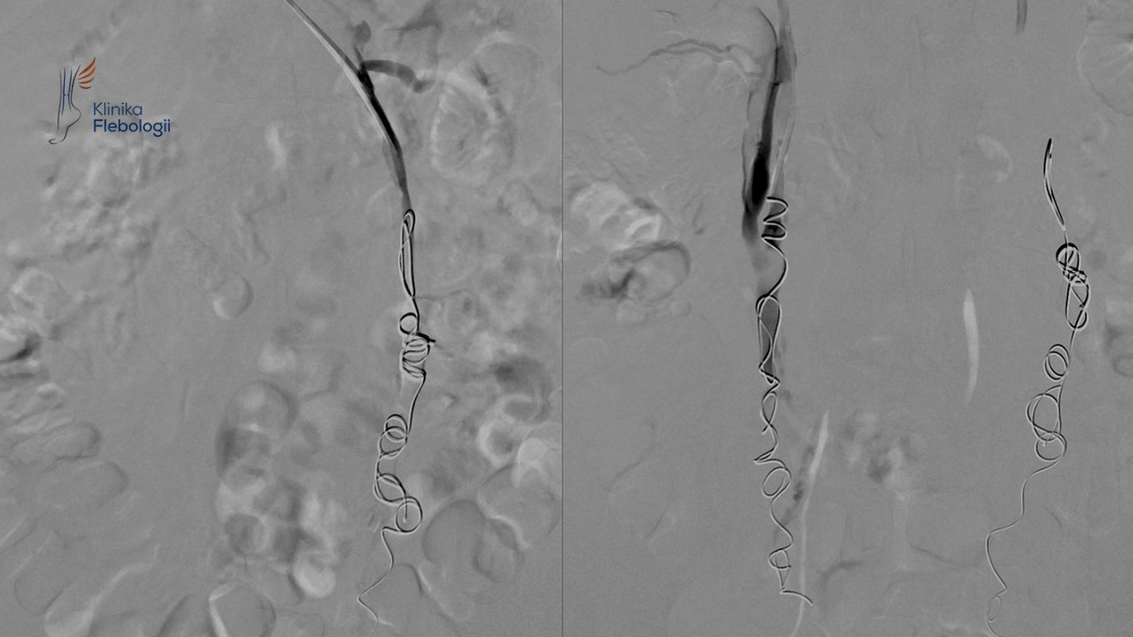 Flebografia i embolizacja żył jajnikowych