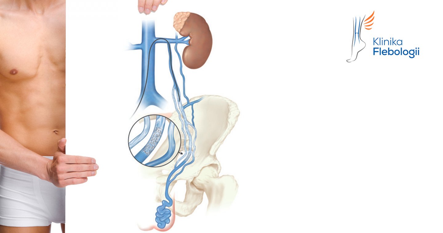 Niewydolność żyły jądrowej. Żylaki powrózka nasiennego