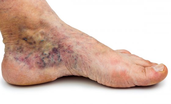 Zespół pozakrzepowy