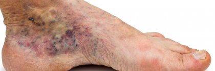 Zespół pozakrzepowy