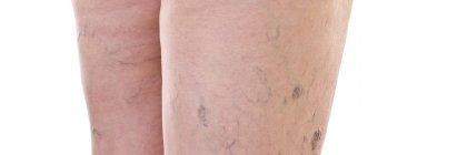 Niewydolność żylna kończyn dolnych