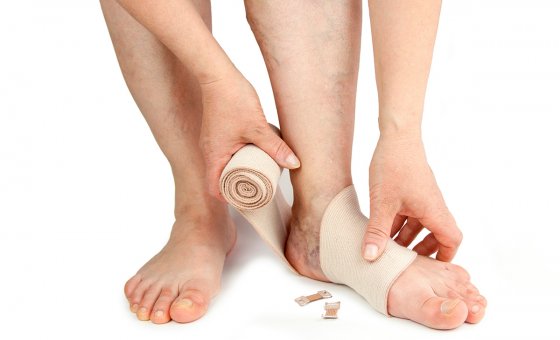 Owrzodzenia żylne goleni