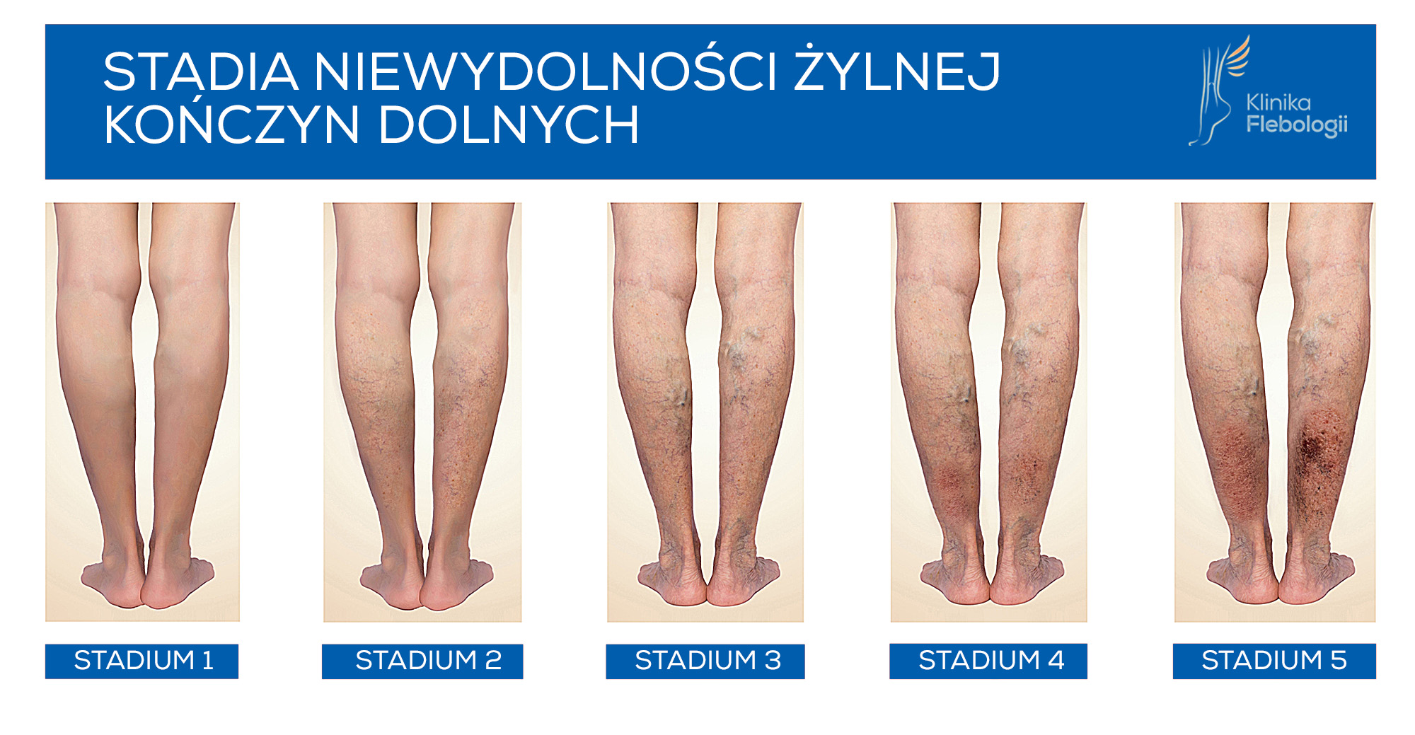Stadia zaawanasowania niewydolności żylnej kończyn dolnych