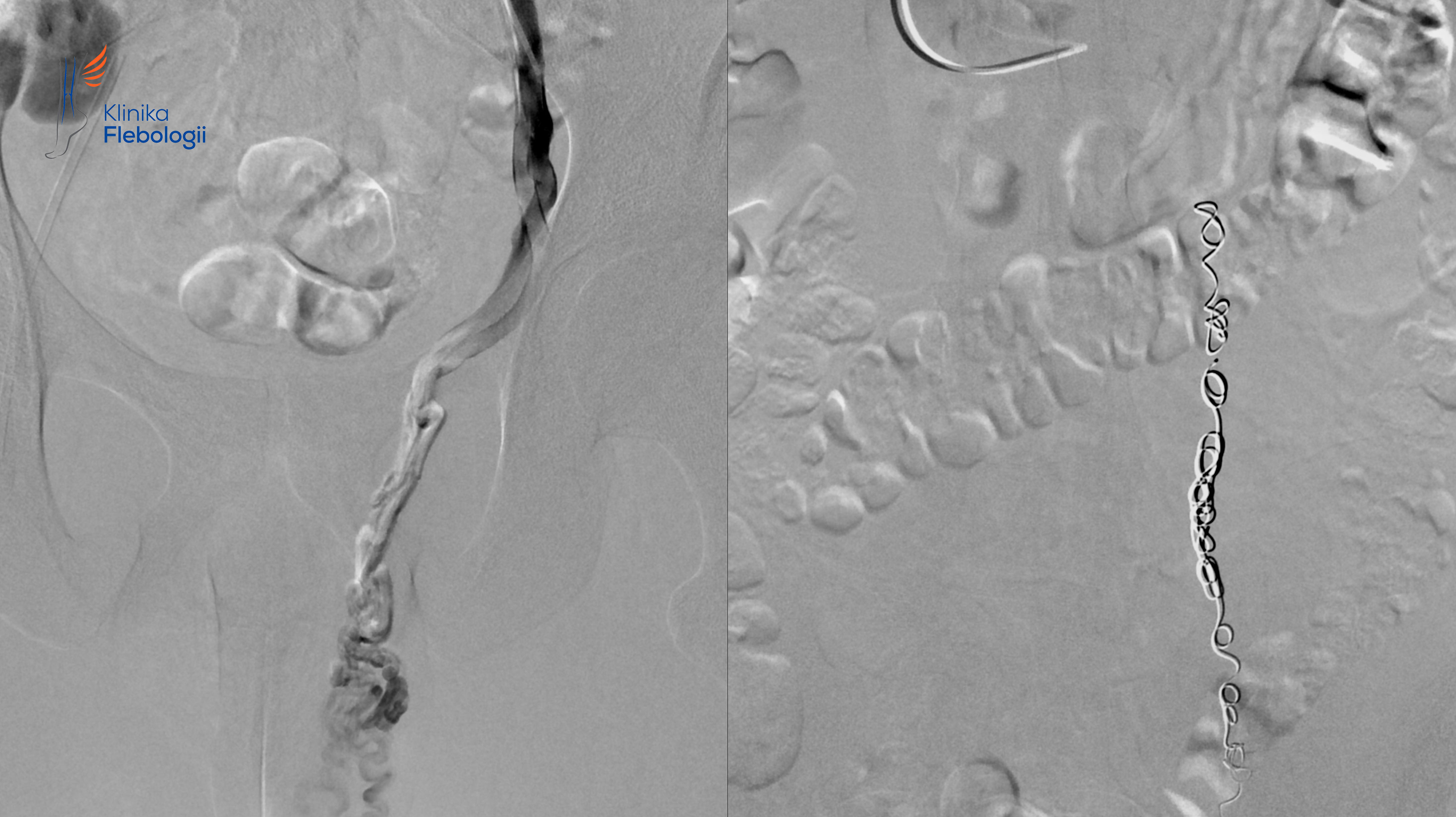 ŻYLAKI LEWEGO POWRÓZKA NASIENNEGO LECZONE PRZY UŻYCIU EMBOLIZACJI WEWNĄTRZŻYLNEJ.