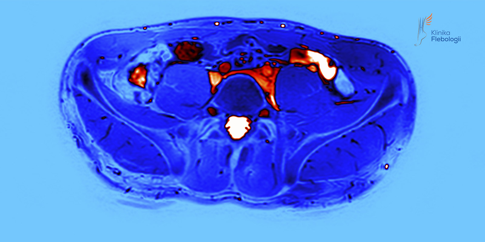  UCISK ŻYŁY BIODROWEJ WSPÓLNEJ LEWEJ W ZESPOLE MAY-THURNERA 